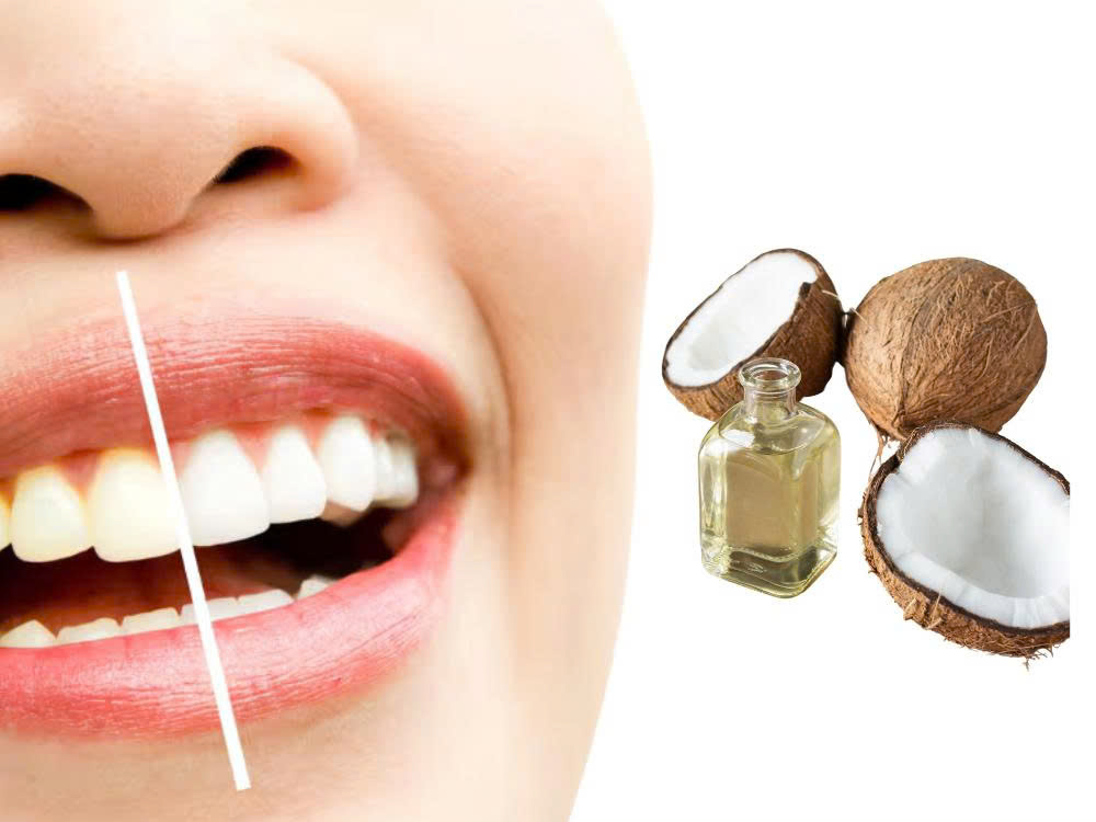 Tẩy trắng răng bằng dầu dừa