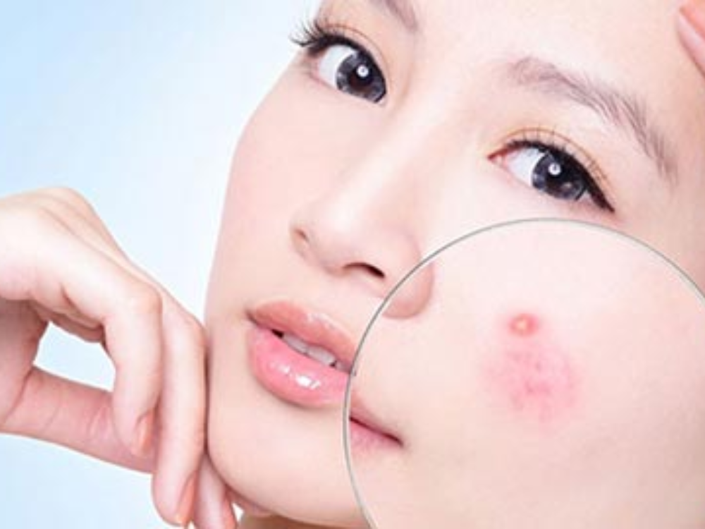 Đặc trị mụn