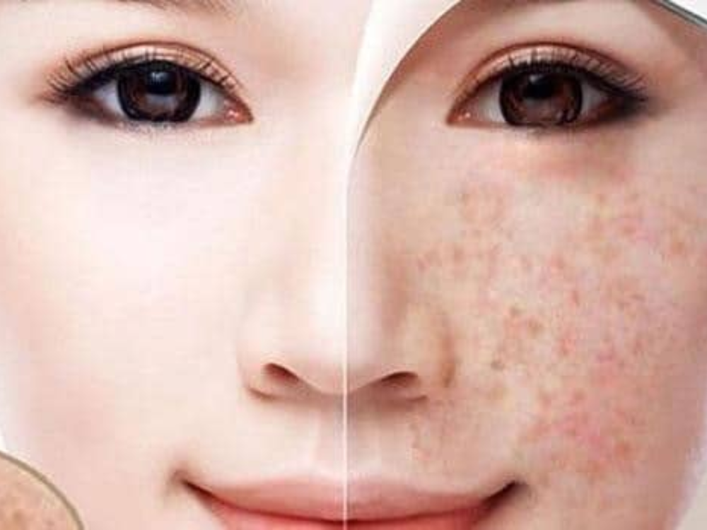 Hỗ trợ làm mờ tàng nhang